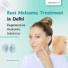 Best Melasma Treatment in Delhi | Regenerative Aesthetic Solutions