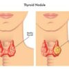 Thyroid Nodule Treatment without Surgery India